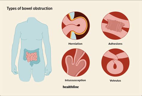 Intestinal obstruction 